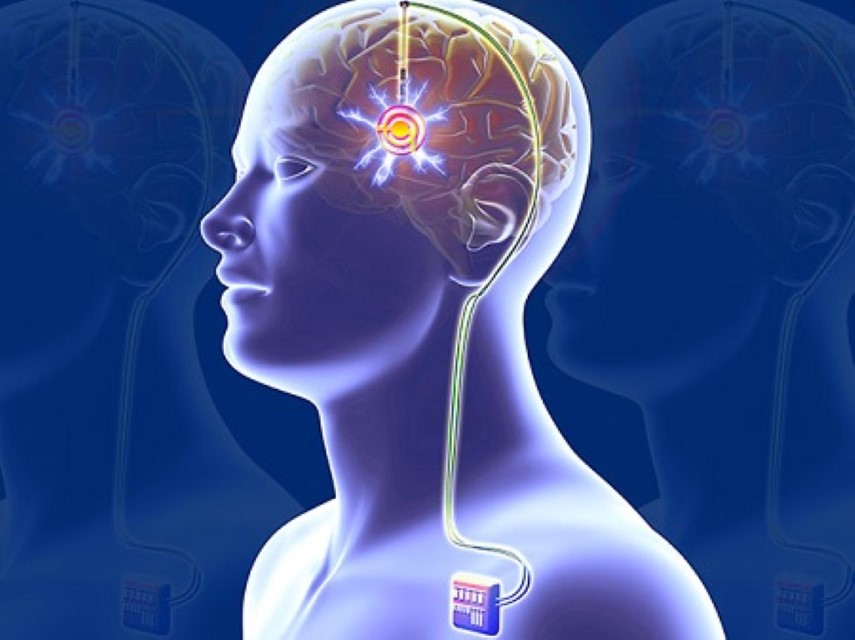 Deep Brain Stimulation,– TechSci Research